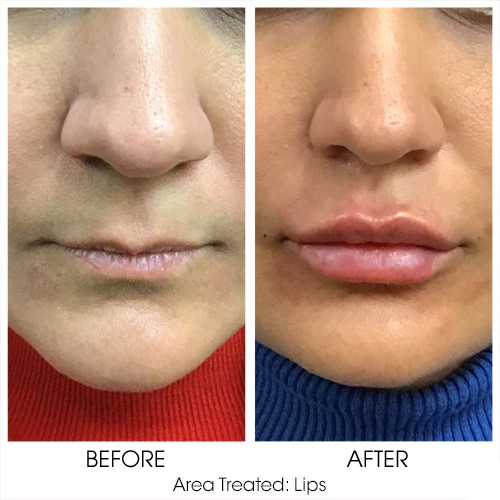 Filler for Lips