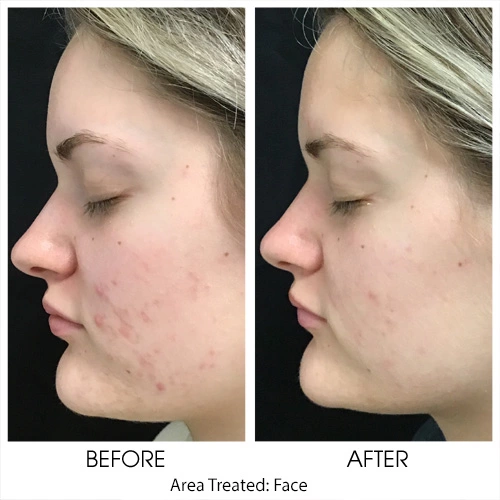 Chemical Peel Before and After