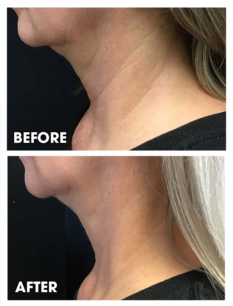 Neck lift