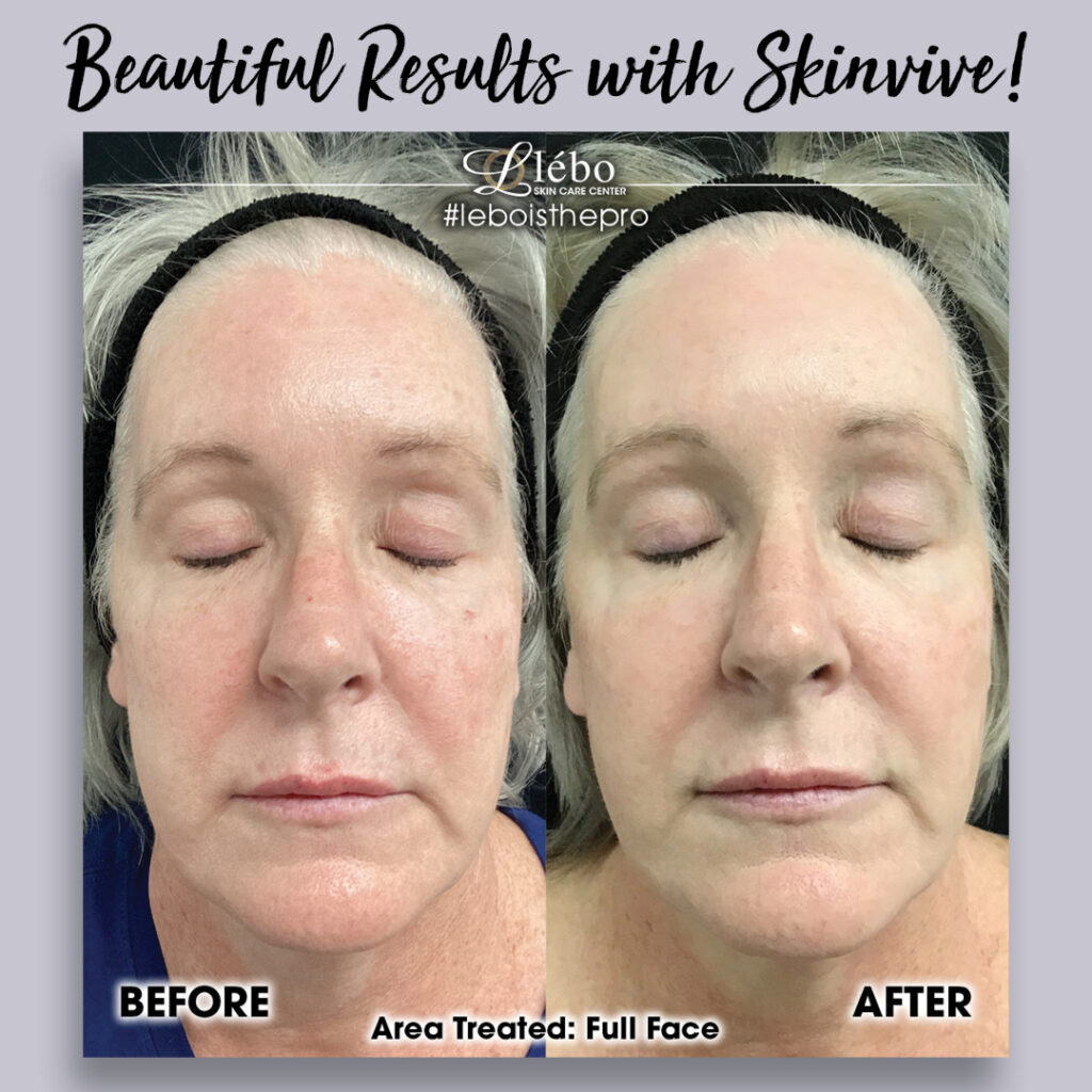 Skinvive Before and After