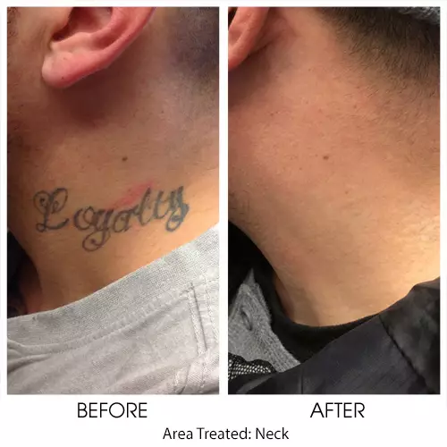 laser hair removal before after neck